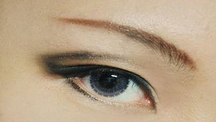 疤痕皮膚可以割雙眼皮嗎？40歲做埋線雙眼皮的效果好不好？