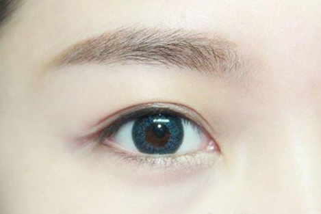 割雙眼皮幾個(gè)月定型？