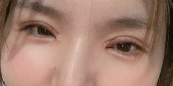 割雙眼皮后要冰敷多久？