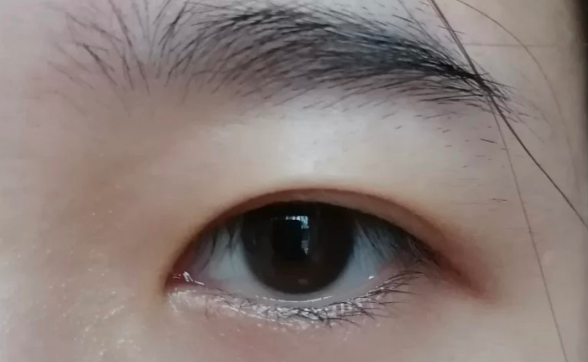 做雙眼皮拆線好還是免拆線好？