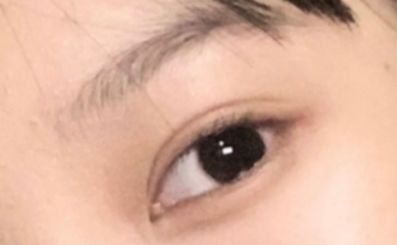 做雙眼皮效果能保持多久？做雙眼皮要冰敷多久？