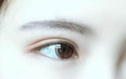開眼角的恢復期要多長？