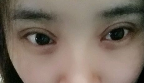 開眼角疼嗎？開眼角術(shù)后會留疤的原因有哪些？