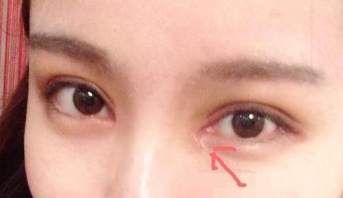 單眼皮開內(nèi)眼角會留疤嗎？