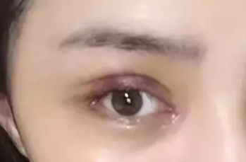 韓式開眼角失敗了怎么辦？