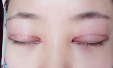 韓式開眼角手術(shù)有哪些優(yōu)勢？開眼角手術(shù)有哪些優(yōu)勢？