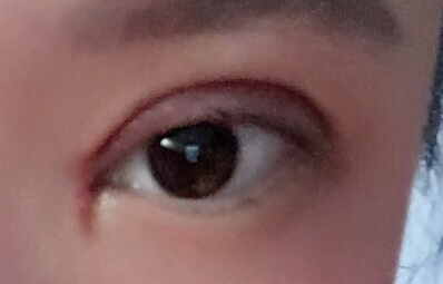 韓式開(kāi)眼角手術(shù)有哪些優(yōu)勢(shì)？