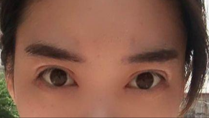 韓式開眼角的有副作用嗎？