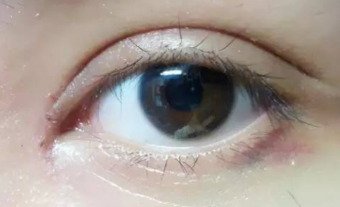 韓式開眼角術后怎么護理？