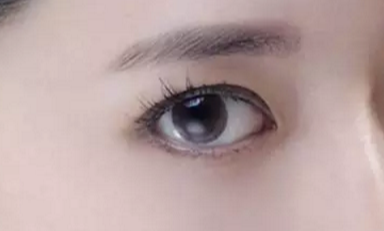 韓式開眼角的手術(shù)費用是多少？