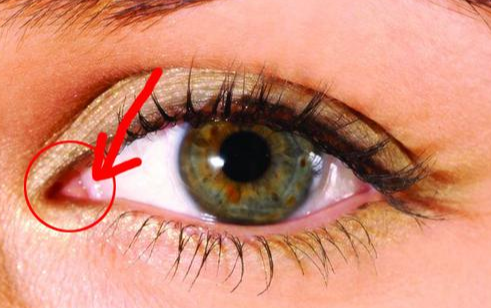 開內(nèi)眼角手術(shù)有什么效果？術(shù)后有哪些注意事項？