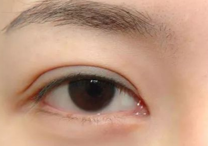 開內(nèi)外眼角多久能恢復(fù)好？開內(nèi)外眼角多少錢？