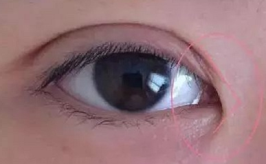 開(kāi)內(nèi)眼角的作用有哪些？