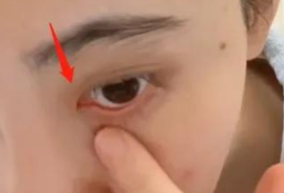 開內(nèi)眼角對(duì)眼睛有傷害嗎？