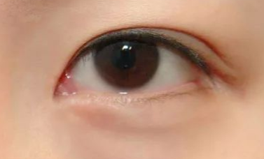 開內(nèi)眼角的優(yōu)缺點有哪些？