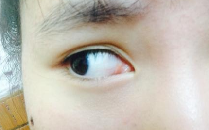 開內(nèi)眼角多久可以回縮？開內(nèi)眼角多久能消腫？
