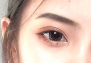 開內(nèi)外眼角怎么消腫快？開內(nèi)外眼角有什么壞處？