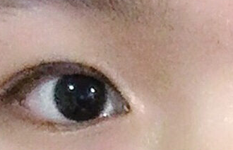 開內(nèi)眼角的危害有哪些？
