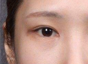 開內(nèi)外眼角腫幾天？