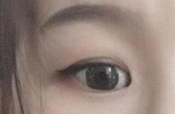 開內眼角的手術費用多少？術后禁忌癥有哪些？