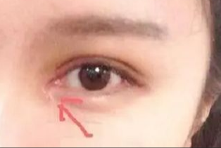 開眼角割雙眼皮拆線嗎？術(shù)后拆線疼嗎？