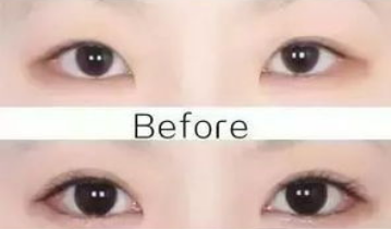 開眼角的危害大嗎？