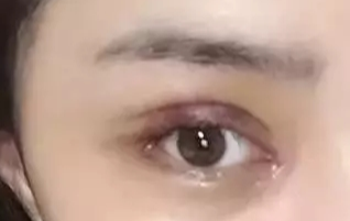開眼角一般要恢復(fù)多久？開眼角一定會出現(xiàn)疤痕嗎？