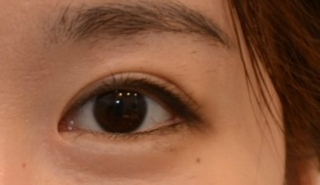 開眼角有效果嗎？開眼角有哪些危害？