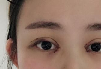 開眼角后多長時(shí)間能恢復(fù)？