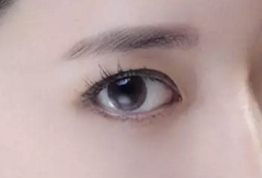 開眼角術(shù)后多久才能恢復(fù)？開眼角術(shù)后防止疤痕增生怎么做？