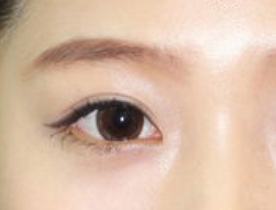 開眼角手術(shù)有哪些適應(yīng)人群呢？開眼角手術(shù)有哪些特點(diǎn)？