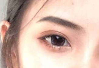 開眼角手術(shù)怎么樣？