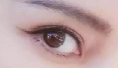 開眼角術(shù)大概要多少錢？