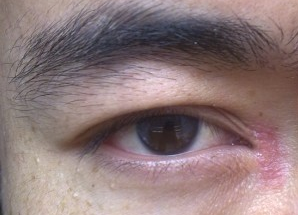 開(kāi)眼角術(shù)后如何快速消腫？