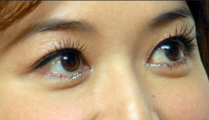 開(kāi)眼角手術(shù)的優(yōu)點(diǎn)有哪些？開(kāi)眼角手術(shù)有哪些安全性？