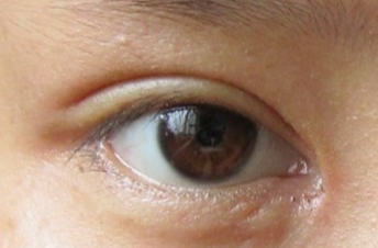 開(kāi)眼角手術(shù)會(huì)不會(huì)留疤？開(kāi)眼角手術(shù)后應(yīng)該注意什么？