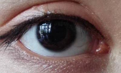 做開眼角疼不疼？做開眼角要多少錢？