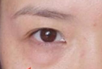 光纖溶脂去眼袋手術(shù)有哪些優(yōu)勢？
