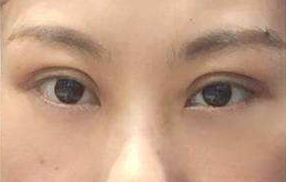 激光去眼袋能維持多長時間？祛眼袋的手術(shù)效果好嗎？