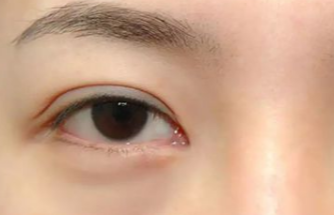 激光去眼袋多久做一次？激光去除眼袋后遺癥有哪些？