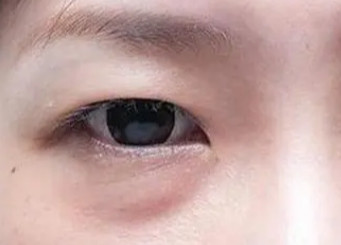 激光祛眼袋有用嗎？