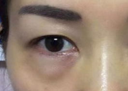 激光可以祛眼袋嗎？激光祛眼袋有哪些副作用？
