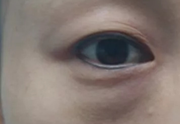 激光去眼袋可以管多久？