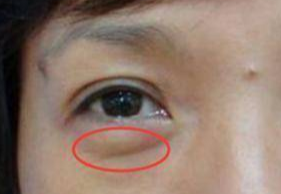 激光去眼袋可以管多久？激光祛眼袋多久可以恢復(fù)？