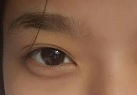 激光去眼袋后需多久能恢復(fù)？激光去眼袋快速有效嗎？