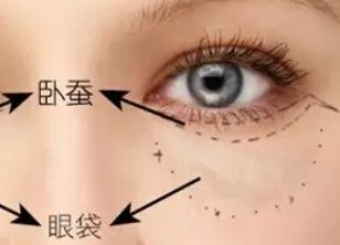 激光去眼袋多久才能恢復？激光去眼袋有什么副作用嗎？