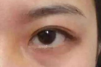 激光祛眼袋效果真的好嗎？激光去眼袋會(huì)有風(fēng)險(xiǎn)嗎？