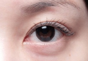 激光去眼袋會不會很疼？激光去眼袋什么人適合？