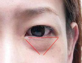 激光除眼袋效果如何？激光去眼袋要注意什么？
