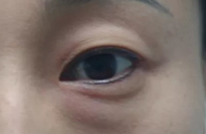 激光去除眼袋效果好不好？